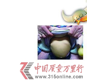 在“聲討金奇仕”的QQ群里,一位媽媽發(fā)的自己寶寶肋骨外翻的照片。 在“聲討金奇仕”的QQ群里,一位媽媽發(fā)的自己寶寶肋骨外翻的照片。