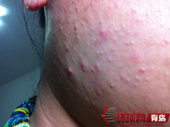 白女士3680元美容療程換來(lái)一臉痘痘。